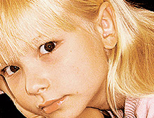 Abstehende Ohren nach OP